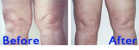 Liposuction Knee